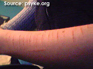 Cuts on the forearm